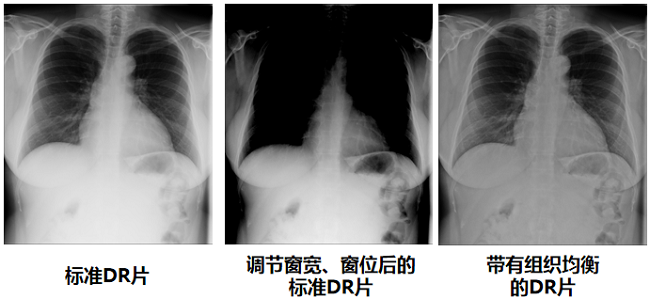 組織均衡技術(shù)讓DR圖像更清晰